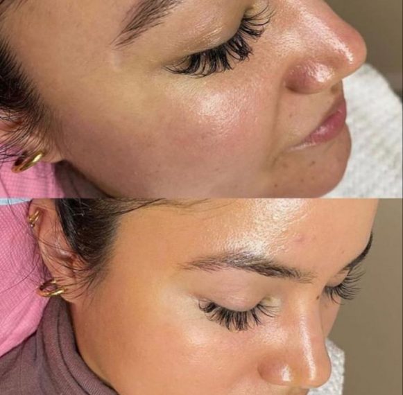 bb-glow-treatment-sydney