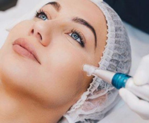 skin-needling-sydney
