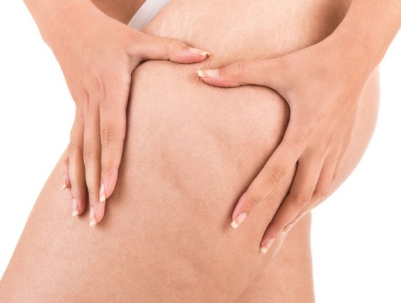 cellulite-reduction-treatment-01