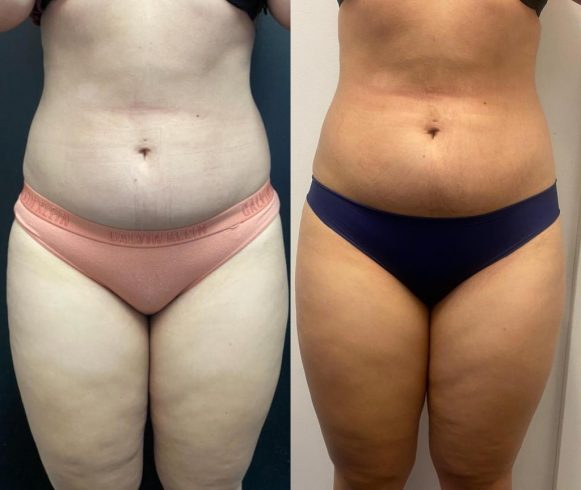 fat freezing image 1